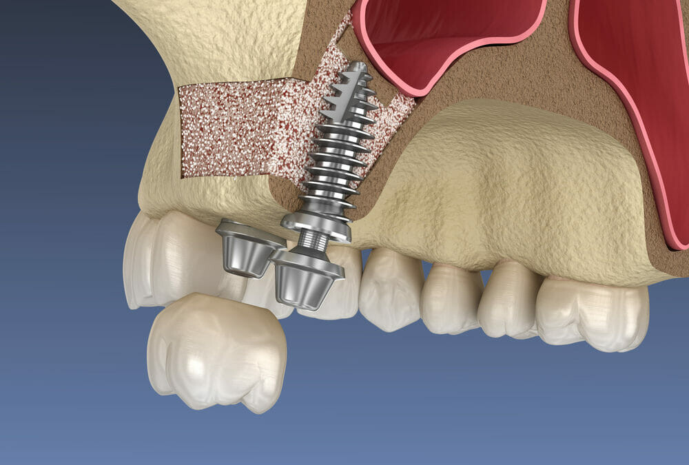 Sinus lift